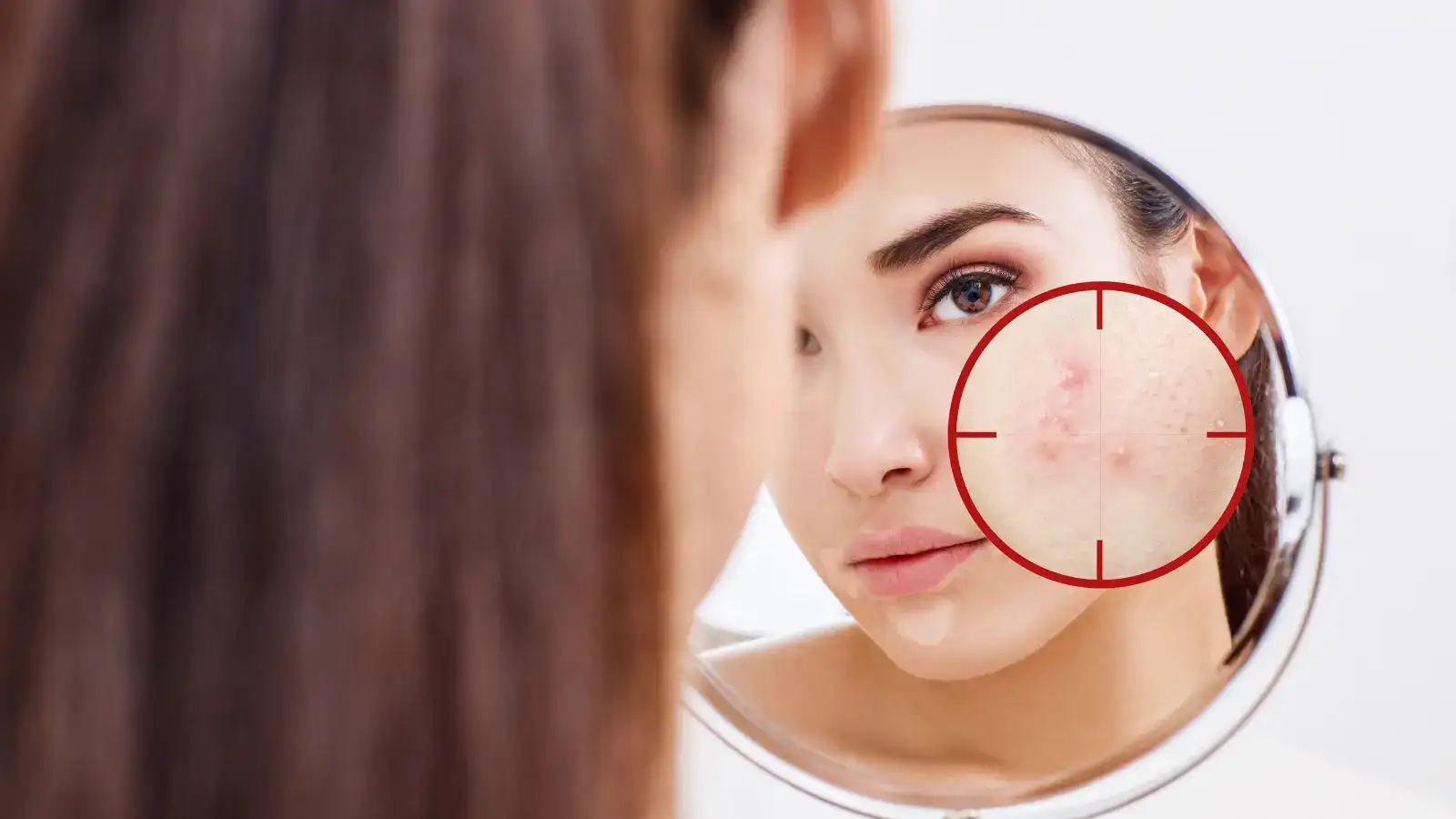 A woman looking into a round mirror, the acne on her cheek circled in red