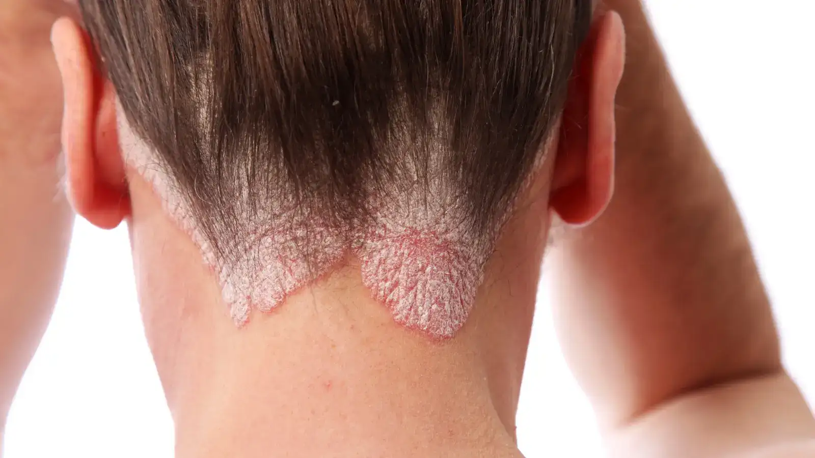 The back of a person's neck and hairline showing scaly psoriasis plaques