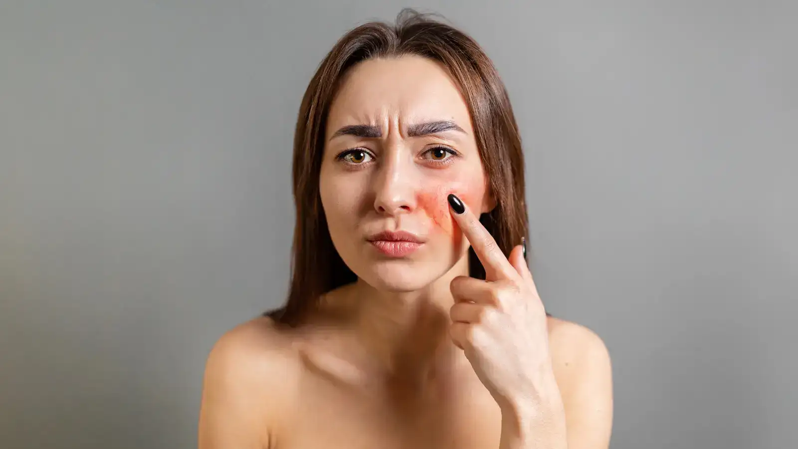 A woman pointing to a reddened patch of skin circled on her cheek
