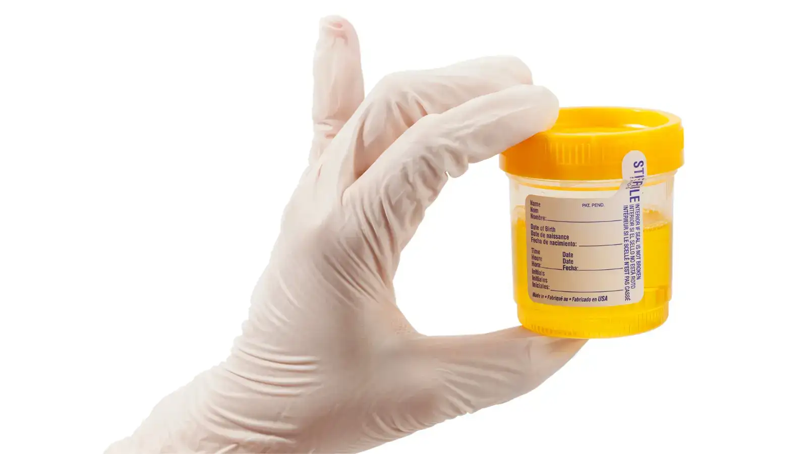 A gloved hand holding a urine sample container with a yellow lid